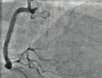 Erfolgreiche Wiedereröffnung (Rekanalisation) des älteren RCA-Verschlusses mit Implan- tation eines medikamentenbeschichteten Stents