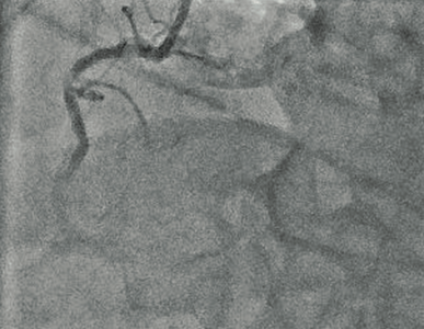 Koronare 1 Gefäßerkrankung Verschluss (RCA: rechte Herzkranzarterie)