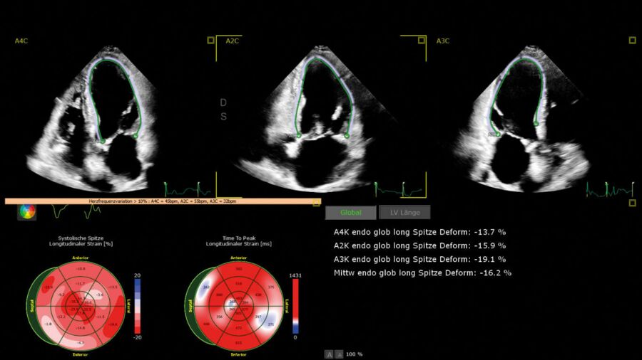 Strain-Analyse (längsgerichtete Deformation des linken Ventrikels).